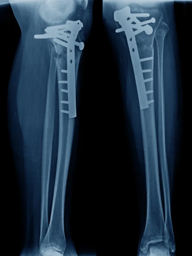 8 Different Types of Fractures